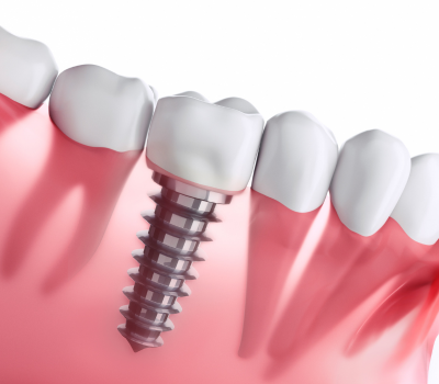 Who Can Benefit from Our Dental Implants?