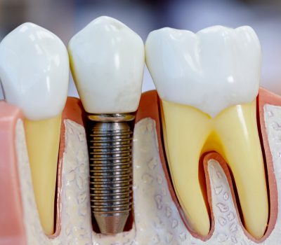 Implant-Supported Dentures