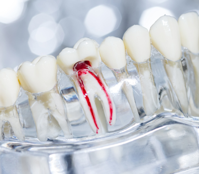 Single-Visit Root Canal